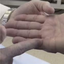 Dupuytren's Contracture - Hand Surgery in a Concert Pianist