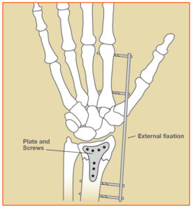 WristFracture_Fig2