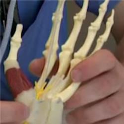 Carpal Tunnel Syndrome: Overview and Treatment (2012) - Video 3